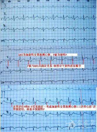 yangchen支持二楼分析,给出标注图如下:      非阵发性交界性心动过速