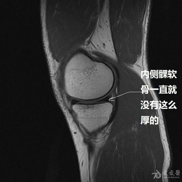 压脂图中外侧髁增厚的软骨信号还有点高    是正常的吗?