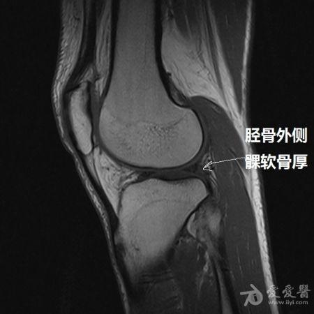 23:10:31     经常遇到这样的情况  这个也是  胫骨外侧髁软骨厚