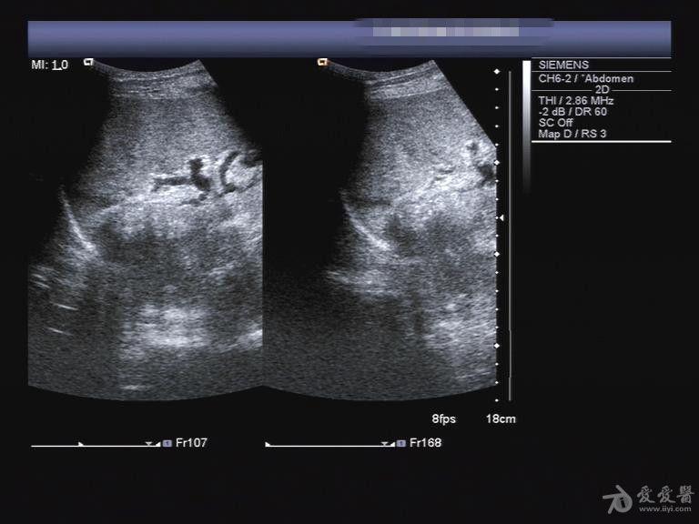 半夜来的脾破裂 - 超声医学讨论版 - 爱爱医医学论坛