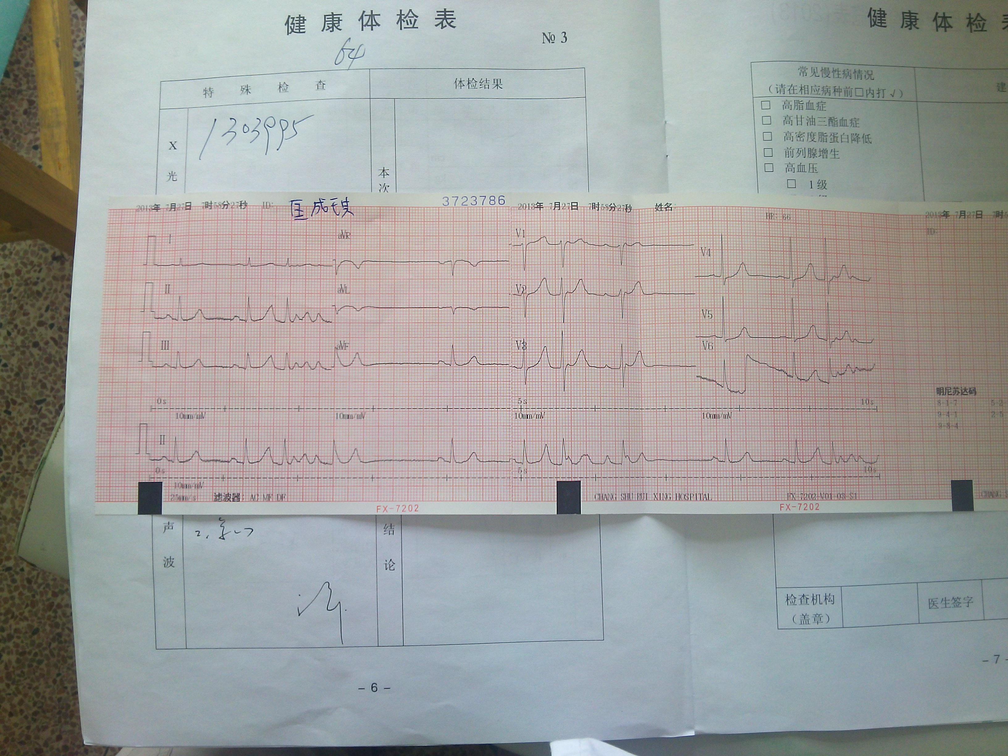 老人健康体检心电图,请大家看看