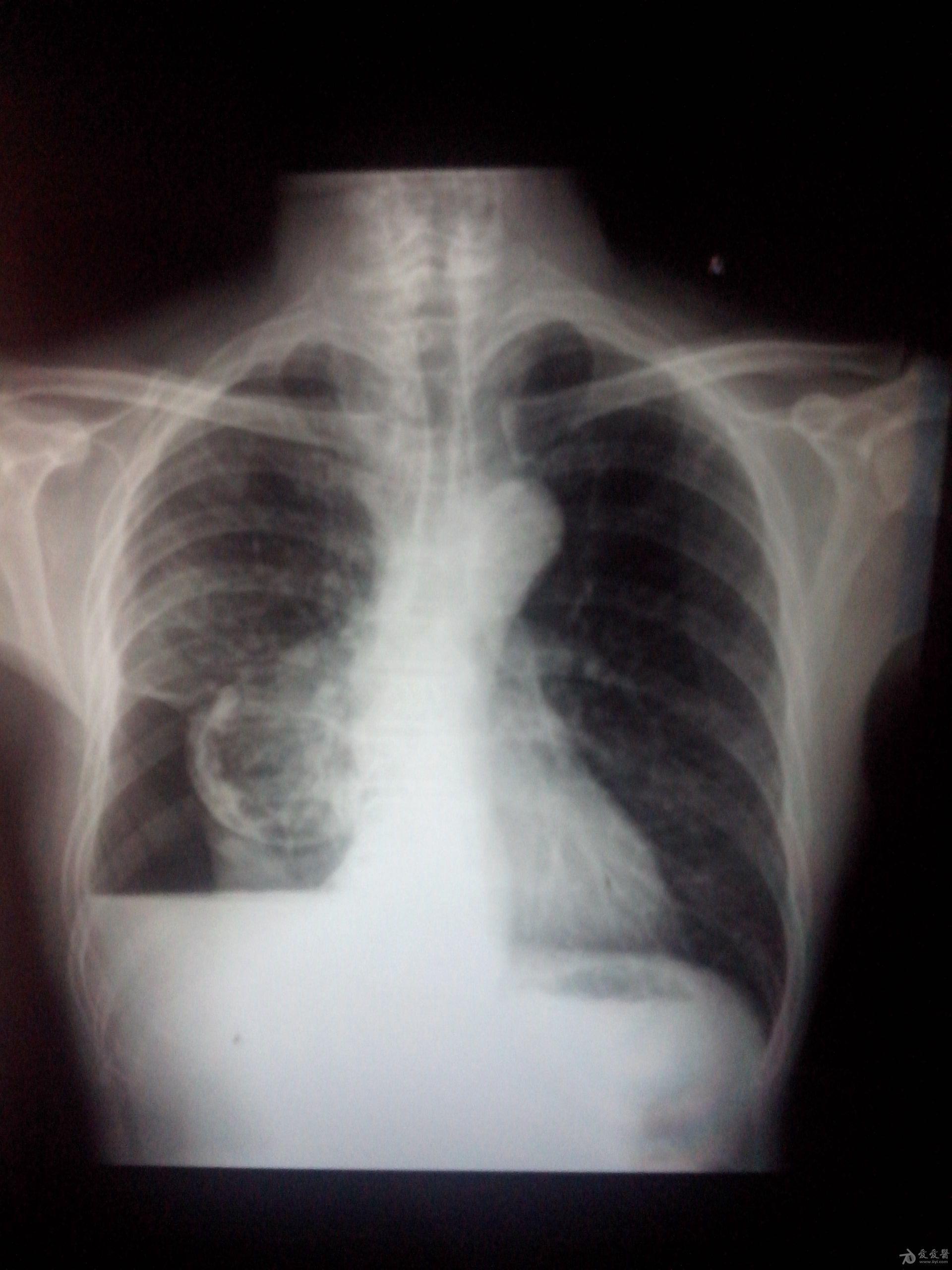 胸片(70岁,男,咳嗽,气喘,发烧,胸腔积液)