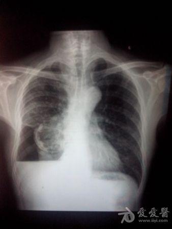 沙发回复qj7992013-08-13 22:43:02右侧液气胸,右肺下方的圆形