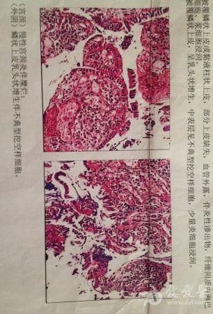 能确诊到底是假性湿疣还是尖锐湿疣吗?(附详细病例)