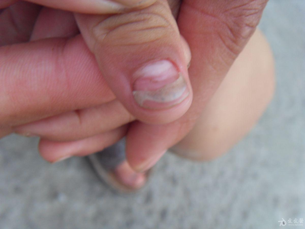 手指甲没有凹陷,及凹凸不平的情况,在没有这个症状之前,检