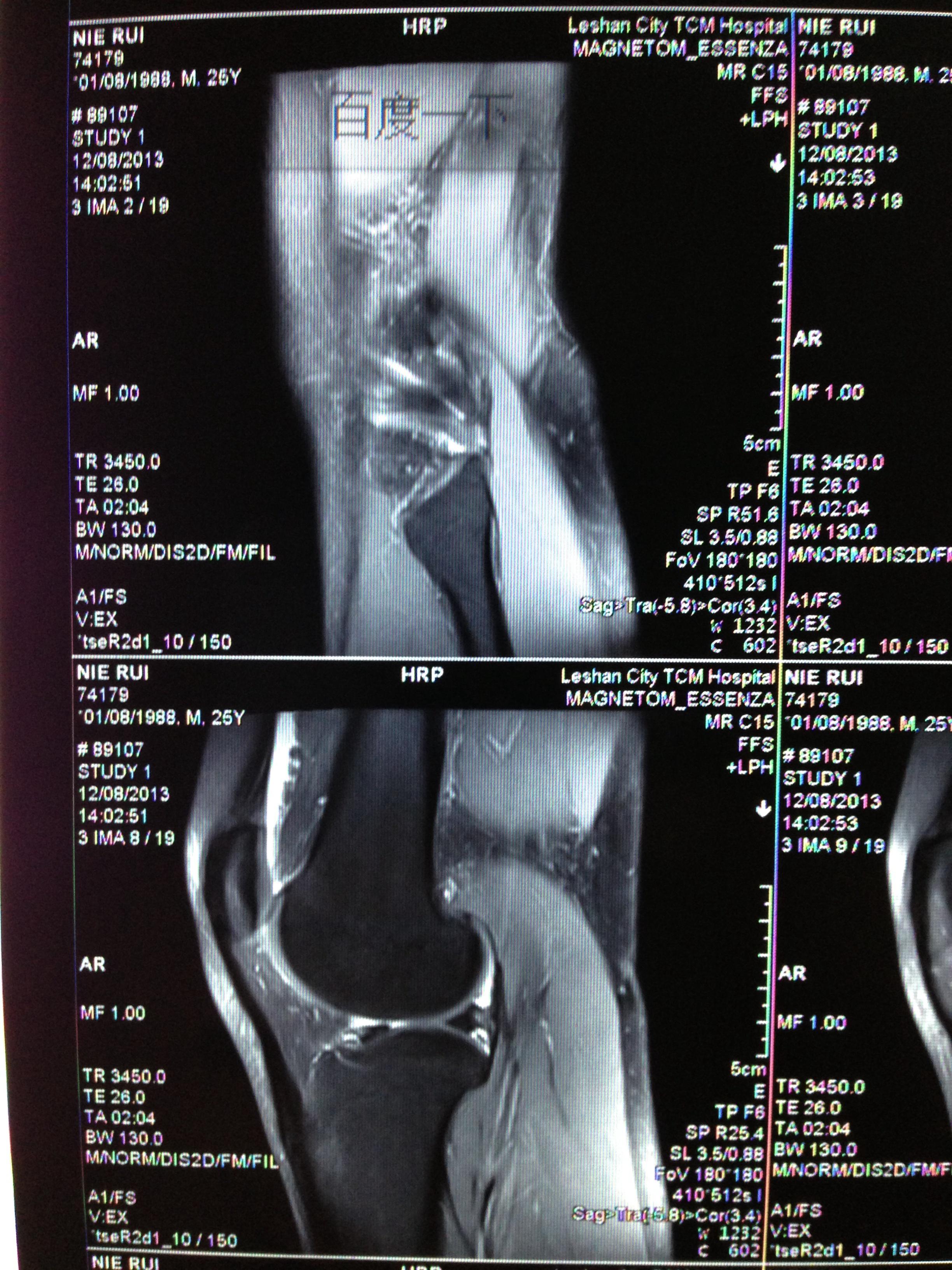 麻烦大家帮忙看看这个右膝关节mri片.