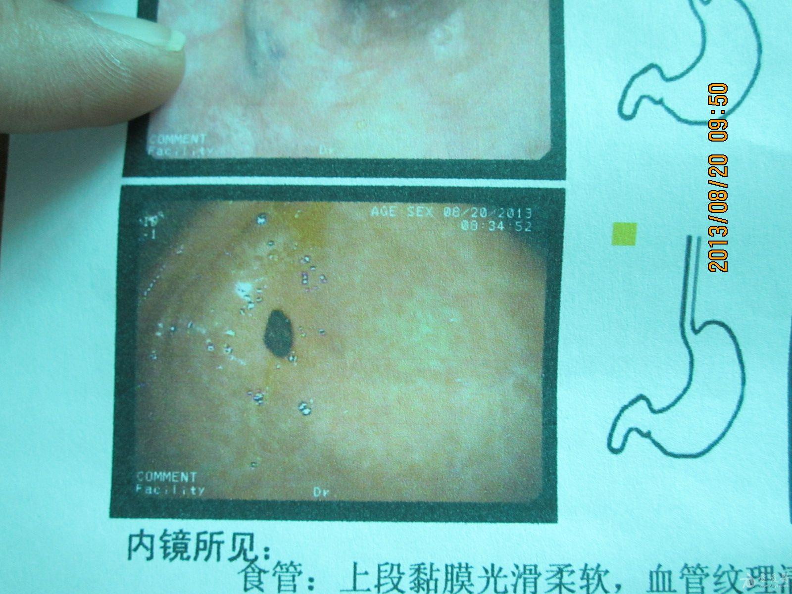 霉菌性食管炎