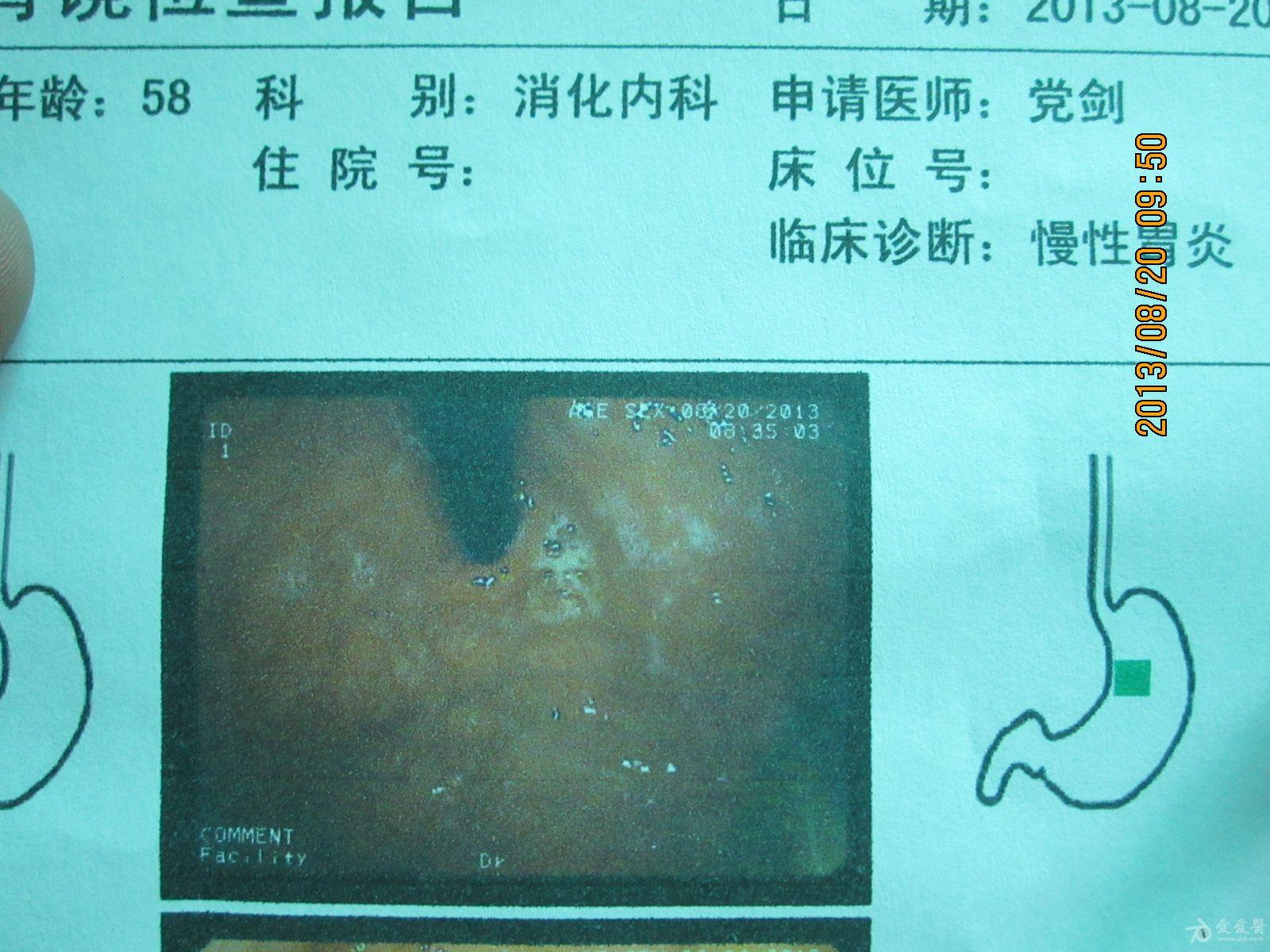 霉菌性食管炎
