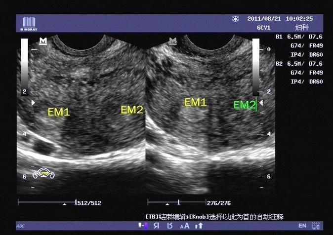 不全纵隔子宫早孕期与非孕期的超声图