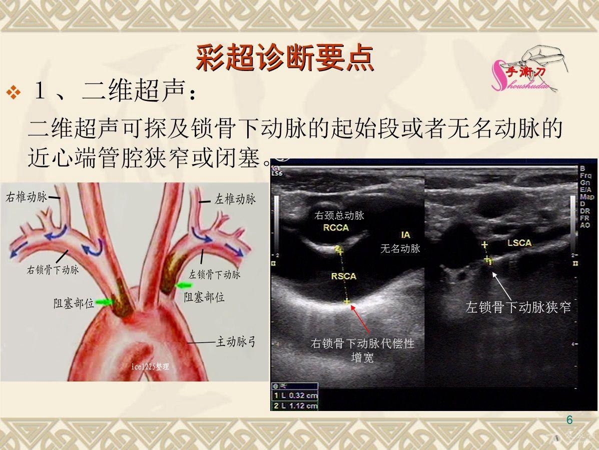 锁骨下动脉窃血综合征超声诊断图解