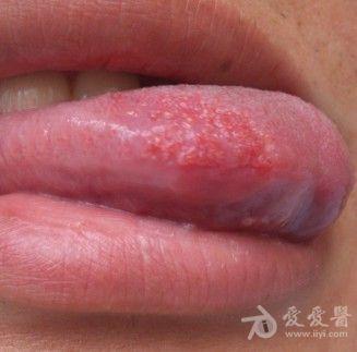 请各位帮我看看,舌尖上右边长了很多小肉刺