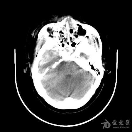 查体见神志尚清,精神差,头面部广泛肿胀,头颅ct示右颞窝硬膜外血肿量