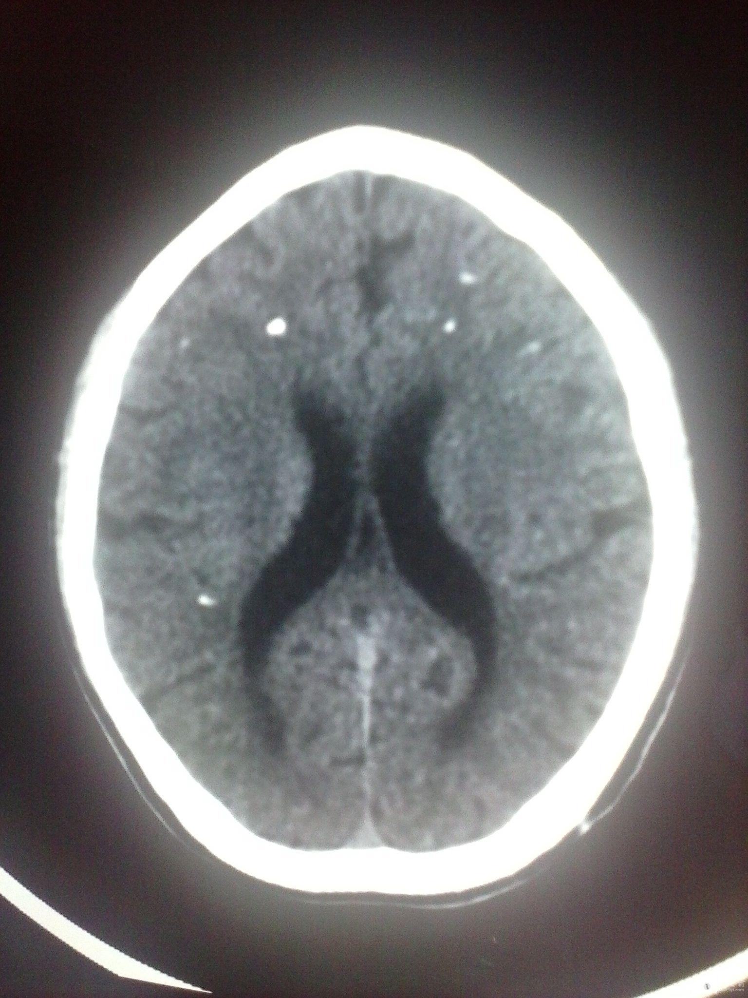 病例34:颅内典型病变-脑囊虫