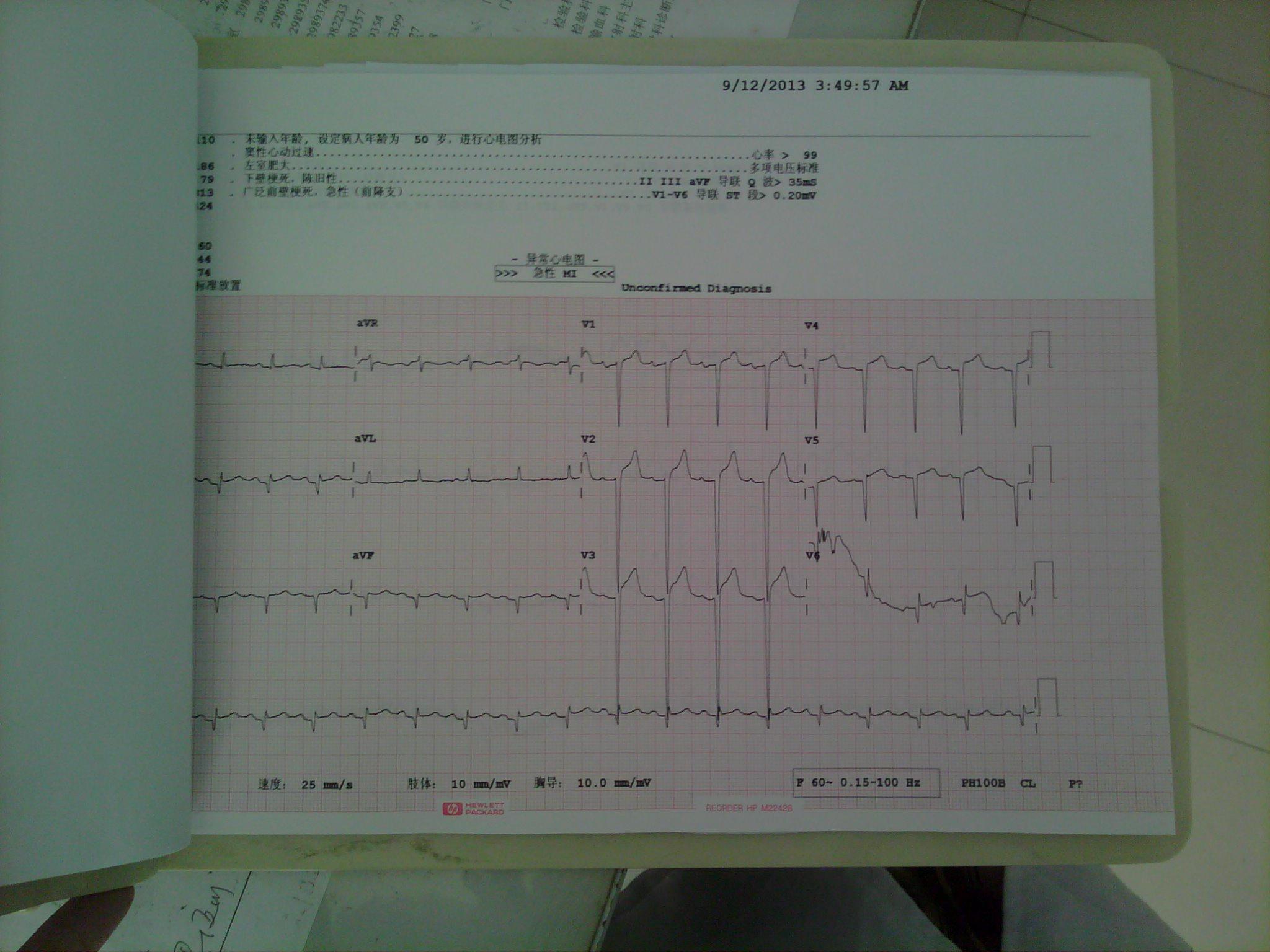 病理性q波心电图分享