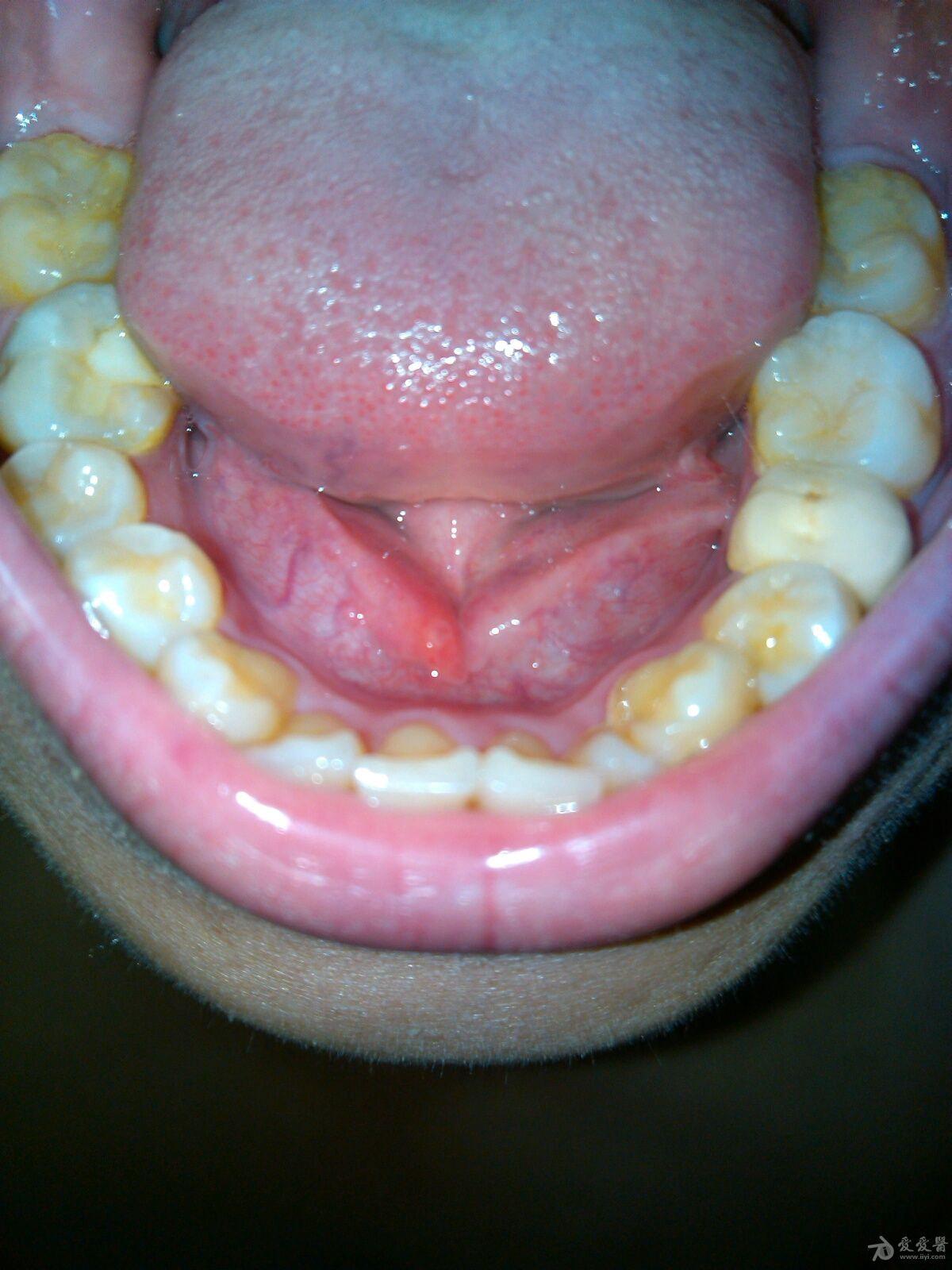 舌下阜长了个小红点,求诊疗