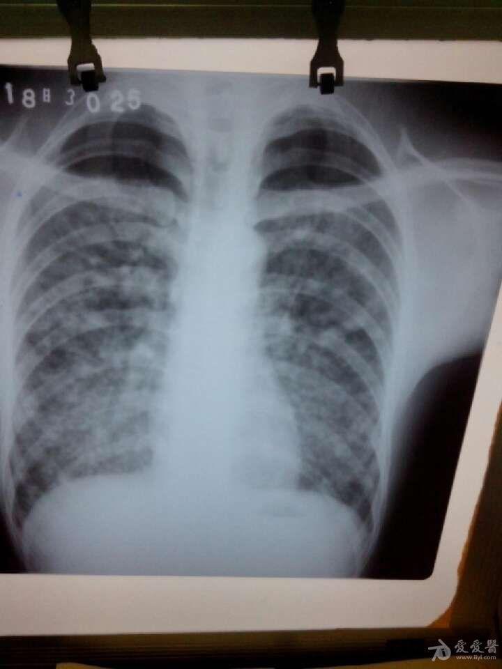 双肺弥漫性病变