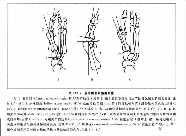 08:16:58   读片会时的录音      拇外翻常见角度测量方法