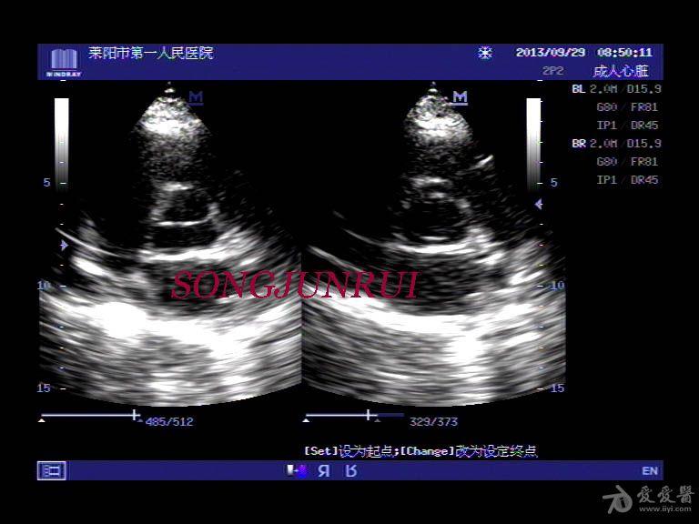 超声入门贴158-----主动脉瓣二瓣化畸形