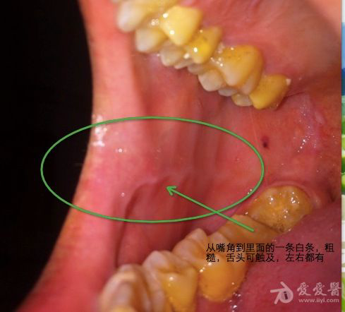 左颌面至耳根有肿痛感,求助医生论断口腔内的那个是不是白班