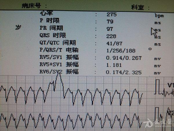 室上速?还有什么?