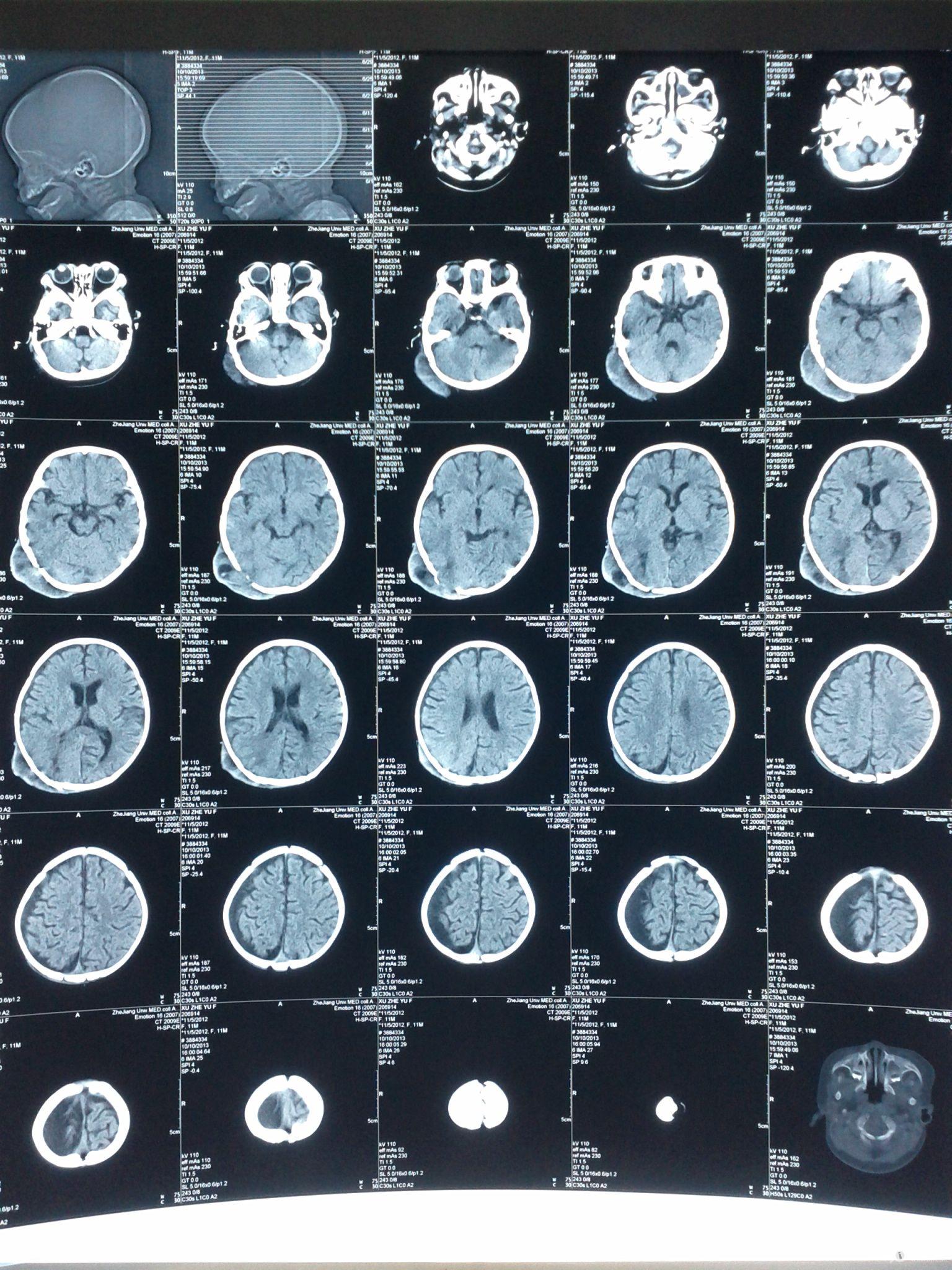 11个半月婴儿颅脑损伤一例求指导