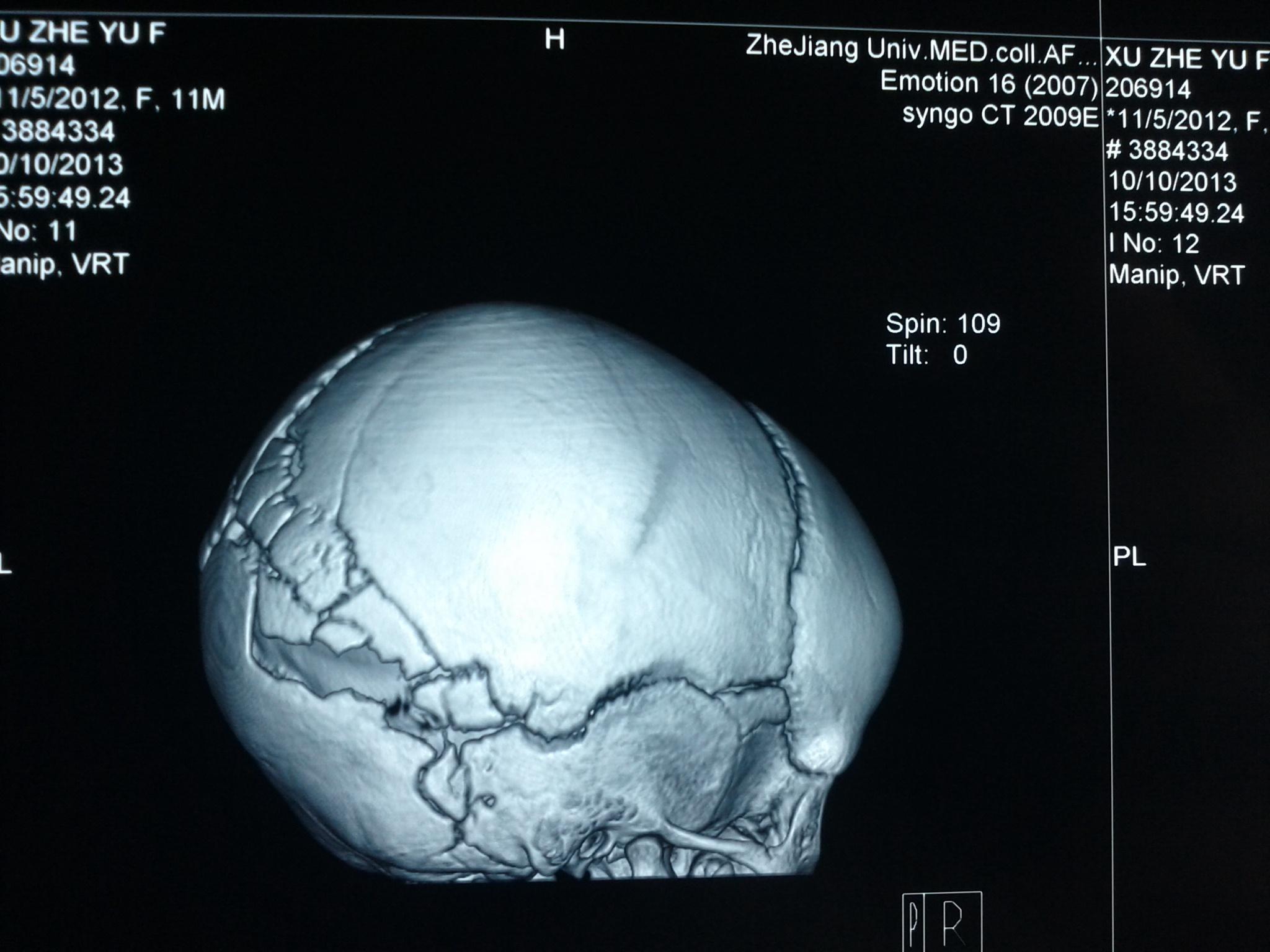 患儿,许哲语,女,11个半月大,9月21号晚上在床上玩耍时摔倒,右枕部直接