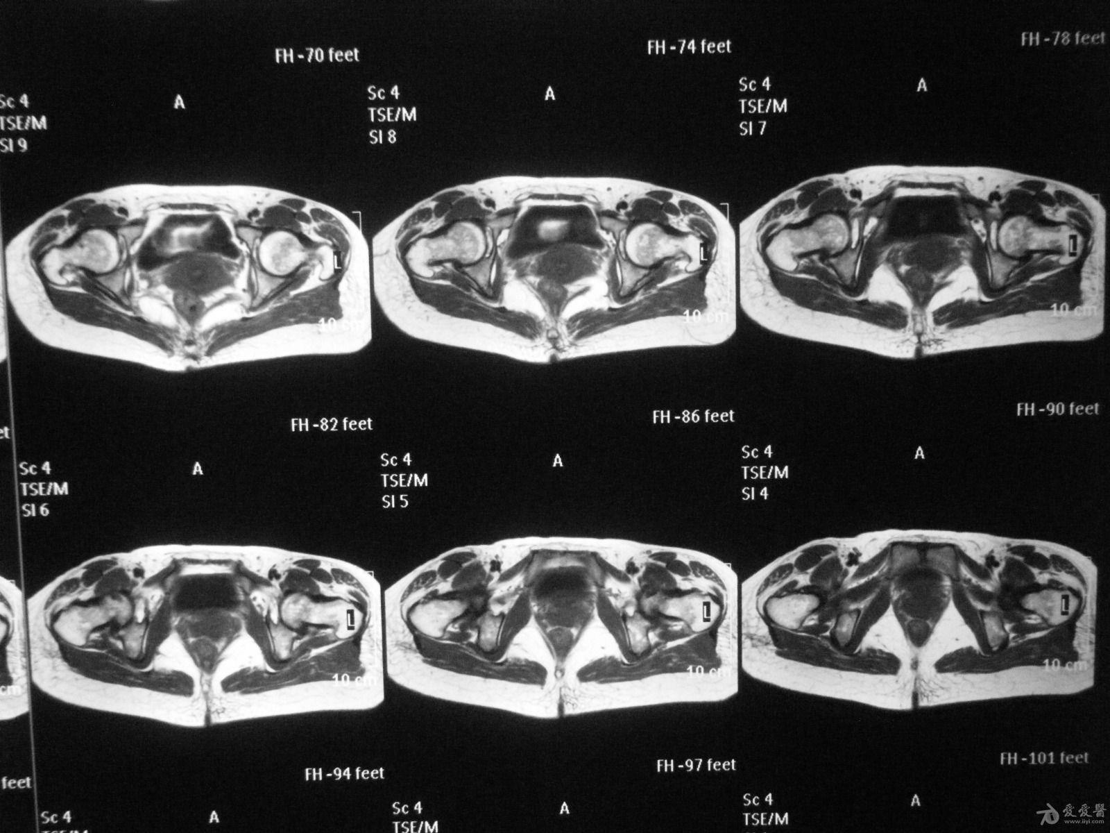 髋关节mri