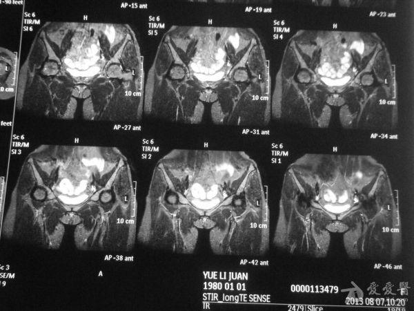 髋关节mri