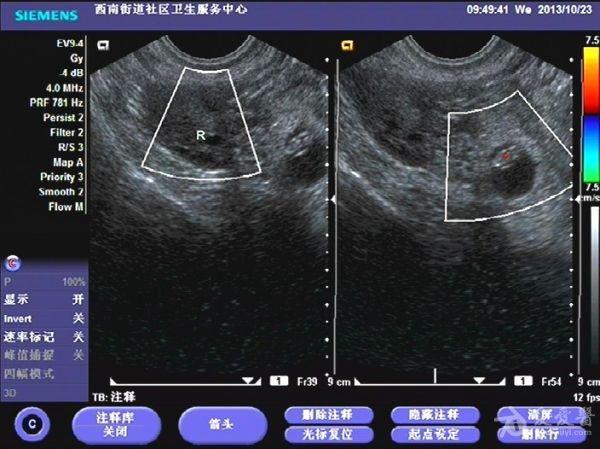 典型未破宫外孕,孕约7 周.