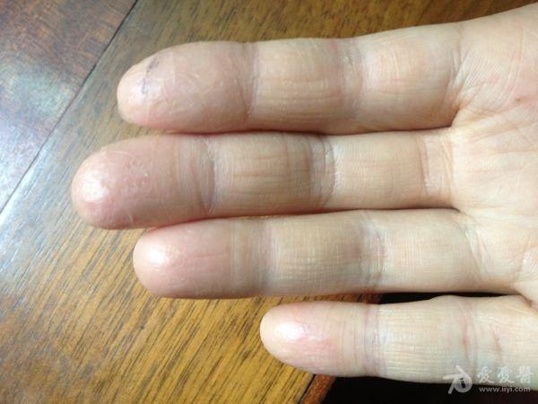 急求方法,手指肚脱皮2年,望专家指点!