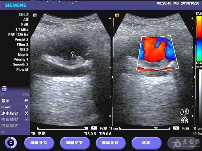 腹主动脉瘤? - 超声医学讨论版 - 爱爱医医学论坛