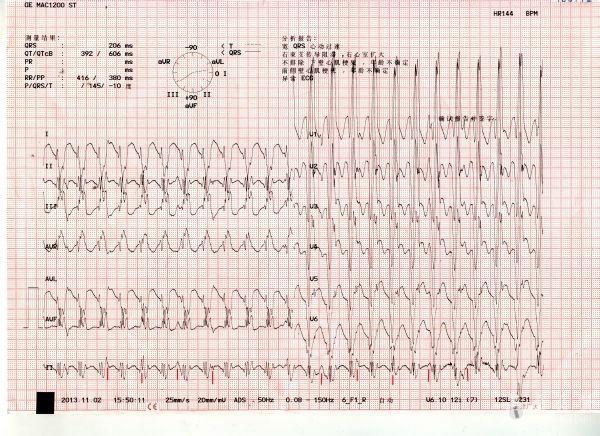 帮看这份心电图