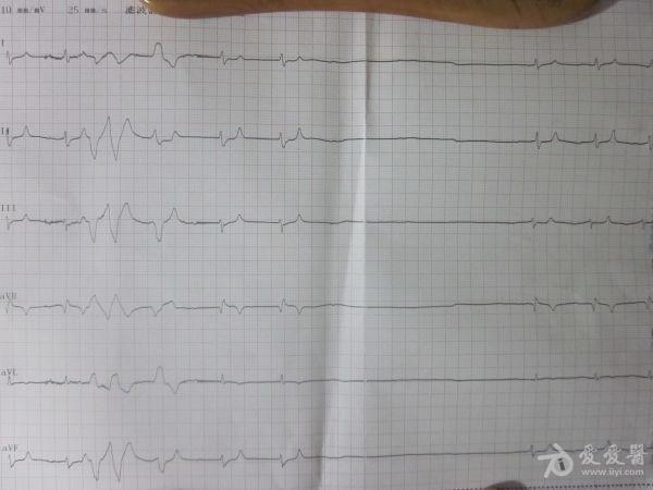 心语2013-11-07 21:53:59   肛肠科患者,抢救当时做图,后抢救无效死亡