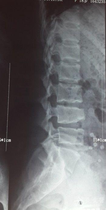 l4椎体楔形改变-请诊断