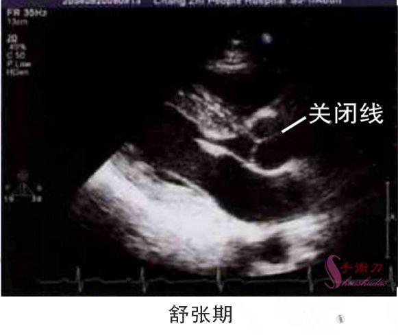 图解二维超声心动图正常值与测量