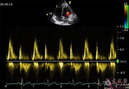图解二维超声心动图正常值与测量