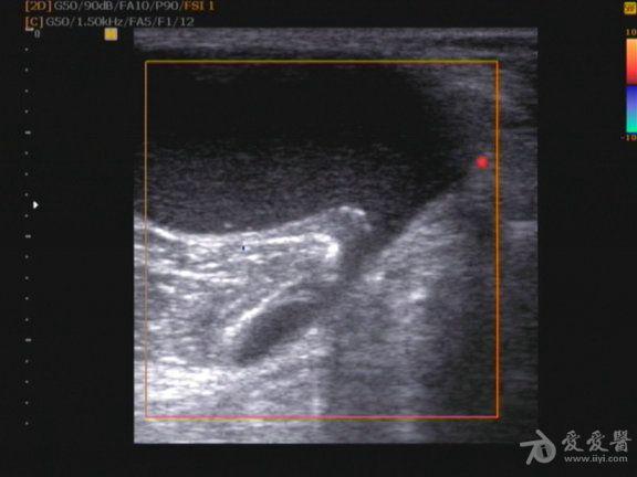 左侧腘窝囊肿 - 超声医学讨论版 - 爱爱医医学论坛 - 爱爱医医学网