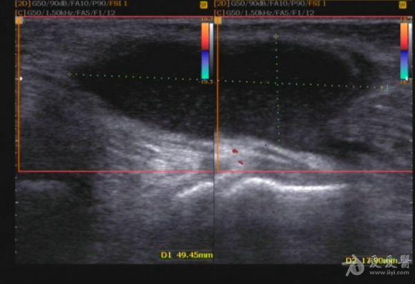 左侧腘窝囊肿 - 超声医学讨论版 - 爱爱医医学论坛 - 爱爱医医学网