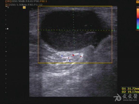 左侧腘窝囊肿 - 超声医学讨论版 - 爱爱医医学论坛 - 爱爱医医学网
