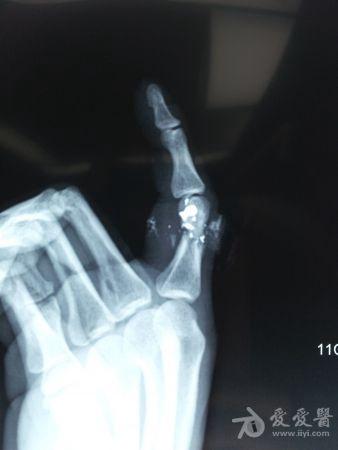 左手食指近节开放性骨折伴指骨缺损