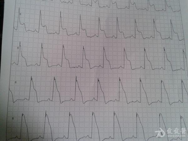 分享一份心绞痛患者心电图的演变过程