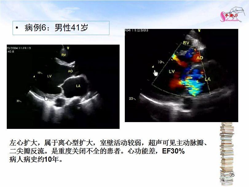 心脏扩大的超声诊断思路