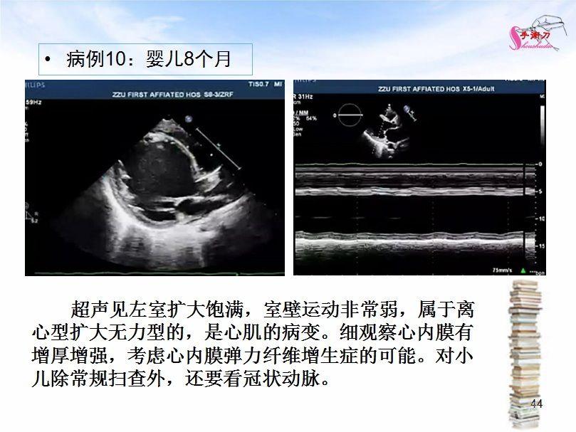 心脏扩大的超声诊断思路