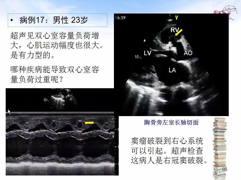 心脏扩大的超声诊断思路