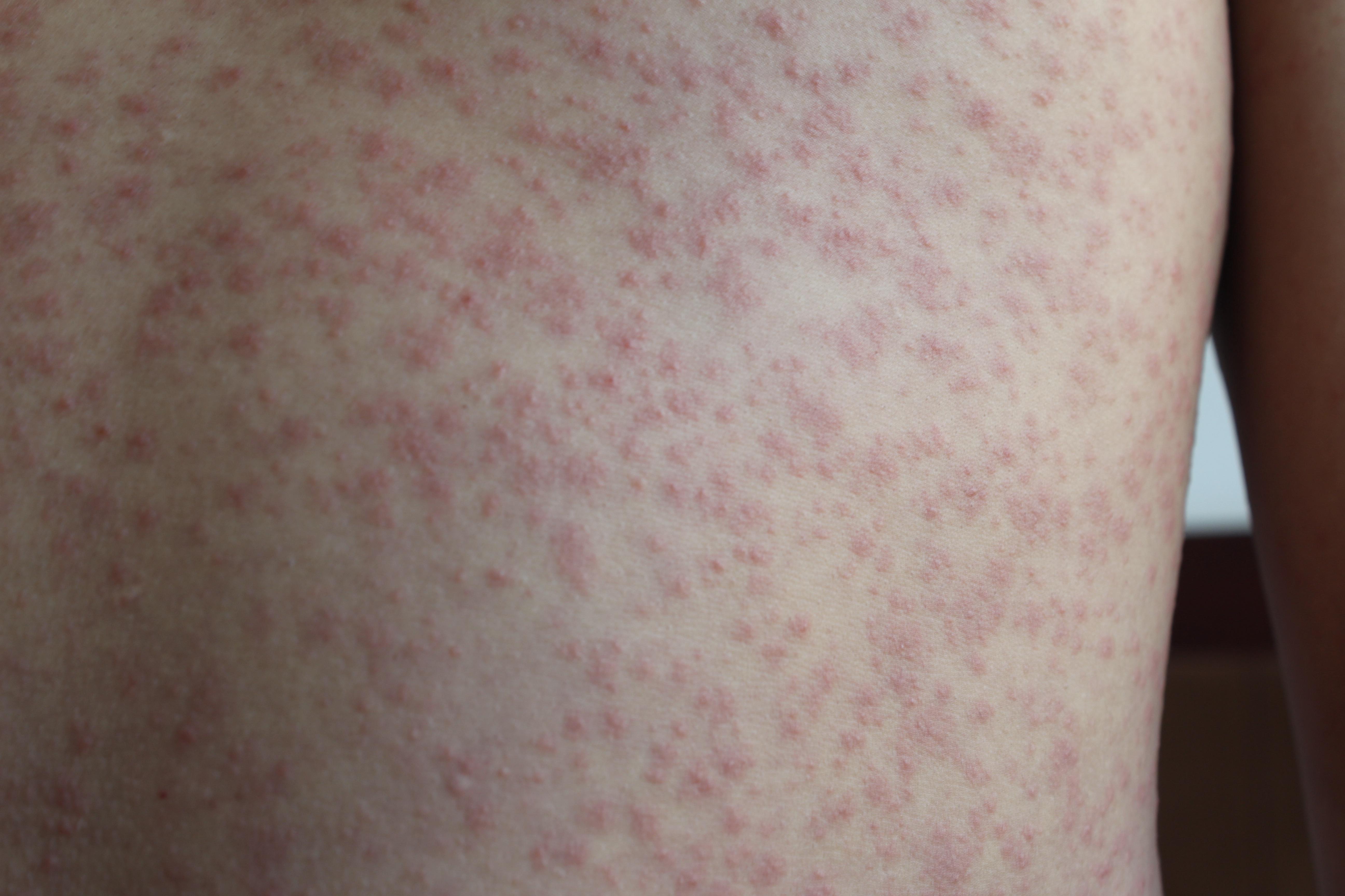 玫瑰糠疹-常见皮肤病-医学