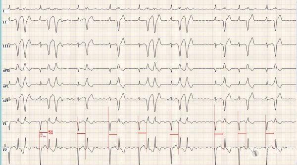房颤情况下出现配对一致的宽qrs波,可以确认是室性早搏二联律.