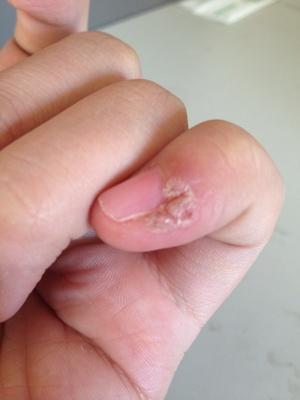 诊断说是寻常疣,液氮冷冻,激光都已经做了几回,总是复发