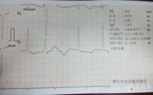 一个死亡者前后两小时的心电图