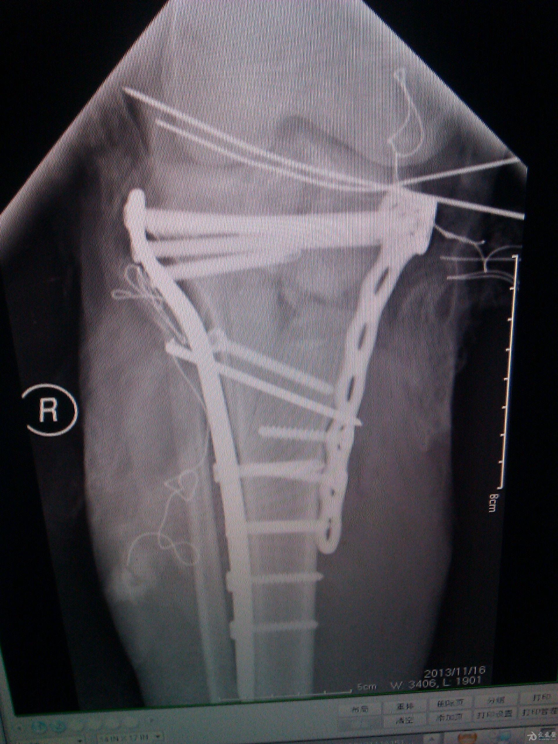 髋膝踝固定支具-骨折医用支架-生产厂家资质齐全