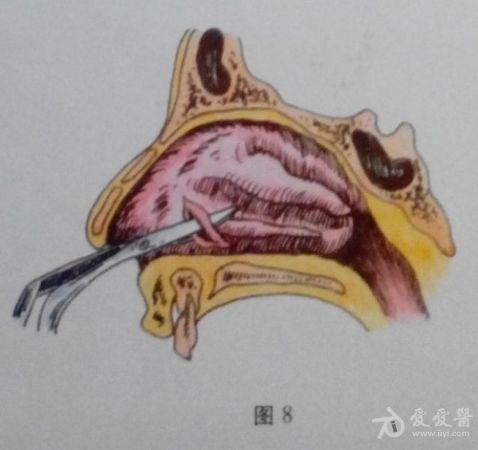 耳鼻咽喉头颈外科手术征集——下鼻甲部分切除术